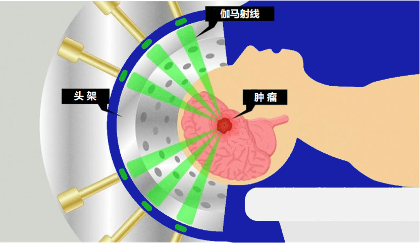 怕开刀？广州东方医院伽玛刀为肿瘤患者开启新希望