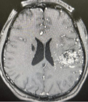 头部治疗利器--头体一体伽玛刀 