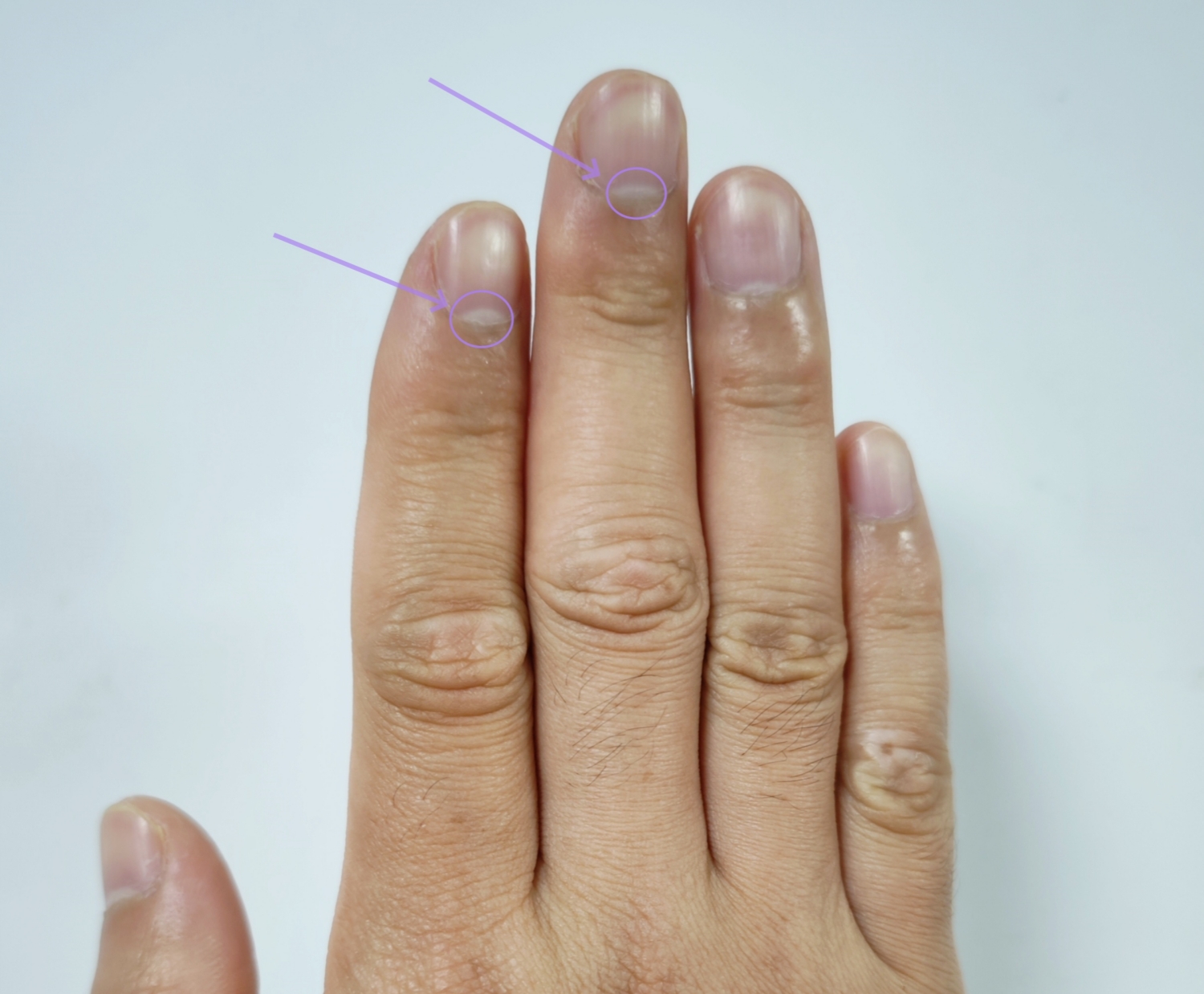 用指甲月牙的数量判断健康,科学吗?医生表示... 用指甲月牙的数量判断健康,科学吗?医生表示...