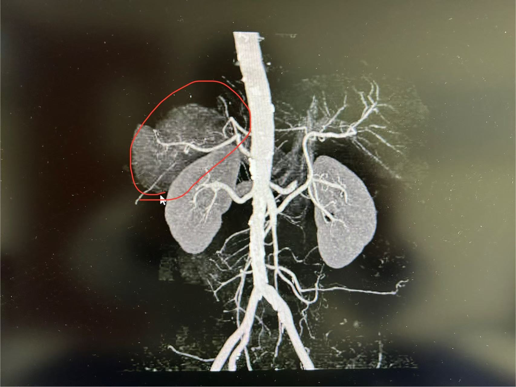 3年没体检,长出9cm肿瘤!医生提醒:警惕“沉默杀手”! 3年没体检,长出9cm肿瘤!医生提醒:警惕“沉默杀手”!